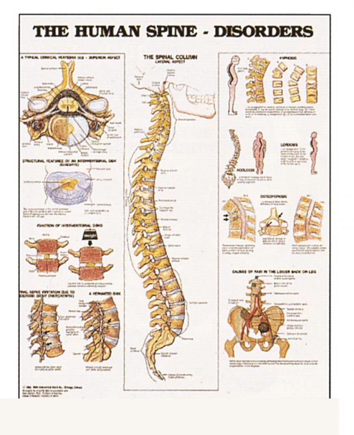 Wall Chart - The Human Spine - Disorders - (Single)